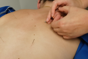 Dry Needling/Acupuncture